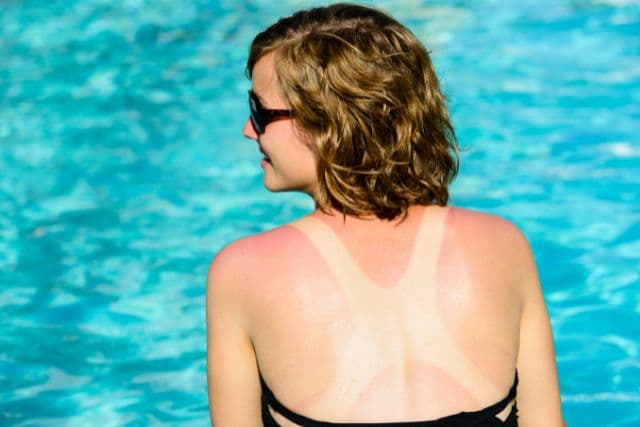 J’ai attrapé un coup de soleil : que faire pour soulager ma peau ?